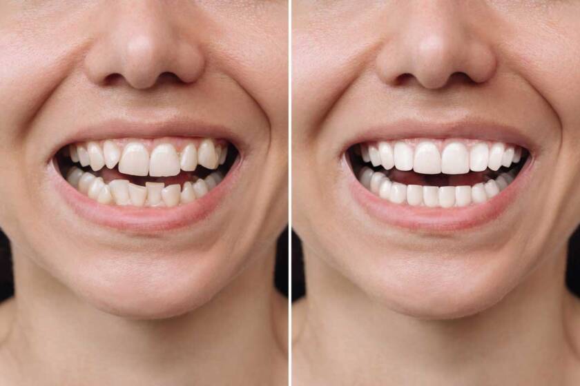 Invisalign