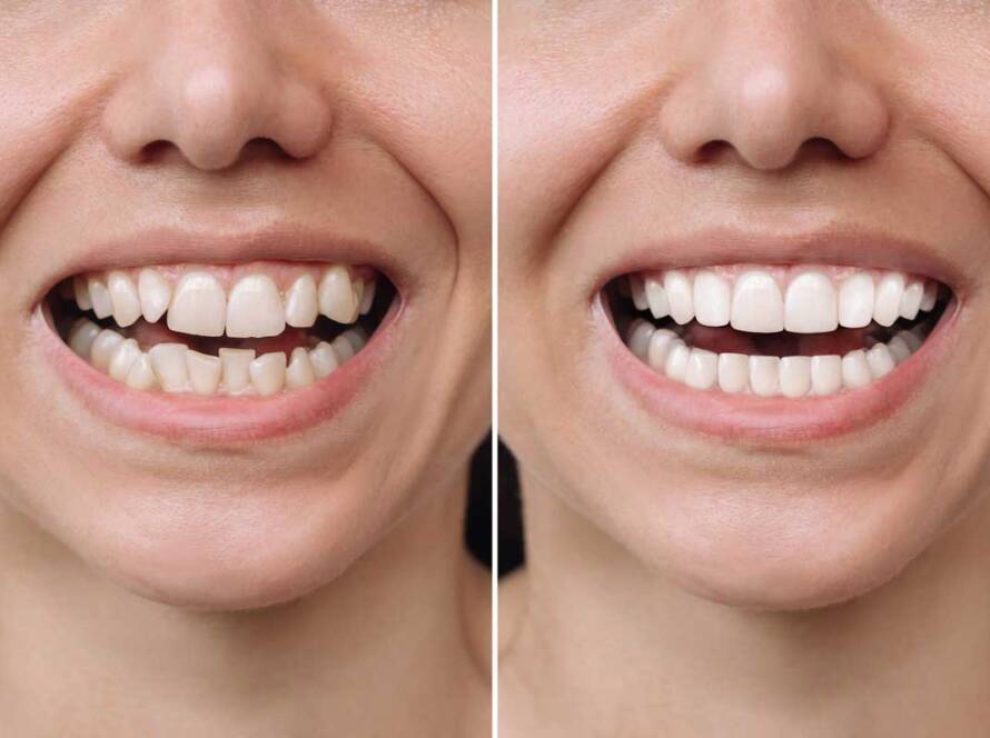 Invisalign