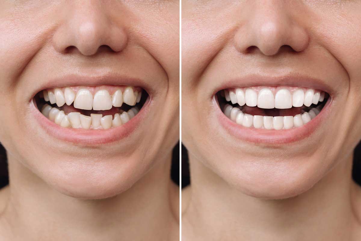 Invisalign