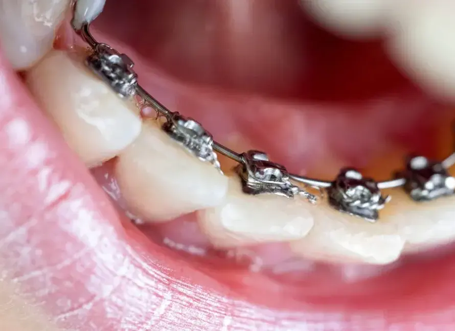 Lingual Braces