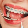 What is the cheapest braces option in Bangalore?