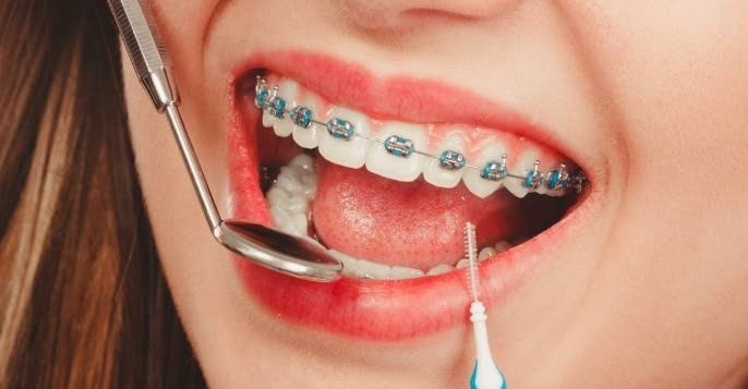 braces