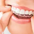 When Should You Get Invisalign?