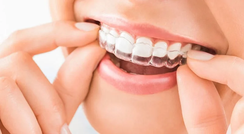 Invisalign clinic