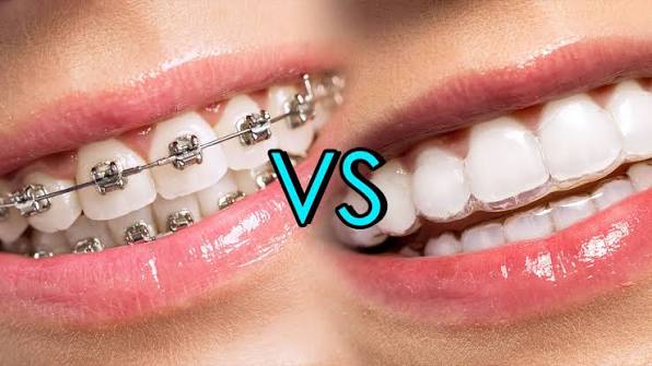 Invisalign Aligners