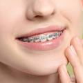 How Do Braces Work? A Simple Guide to How Teeth Move