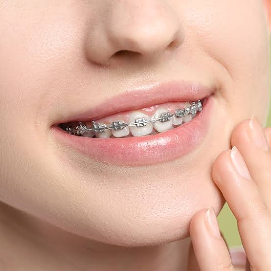 Braces