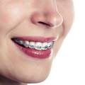 What Is the Best Age to Get Braces? A Guide For Children, Teens and Adults