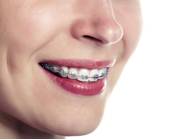 Braces