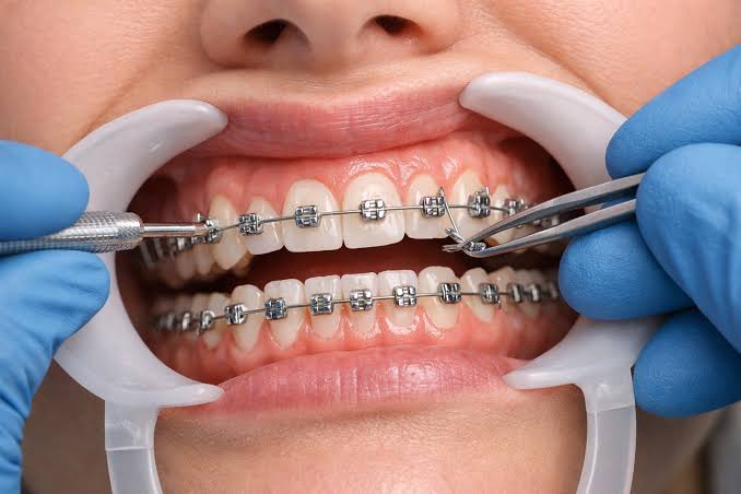 Braces